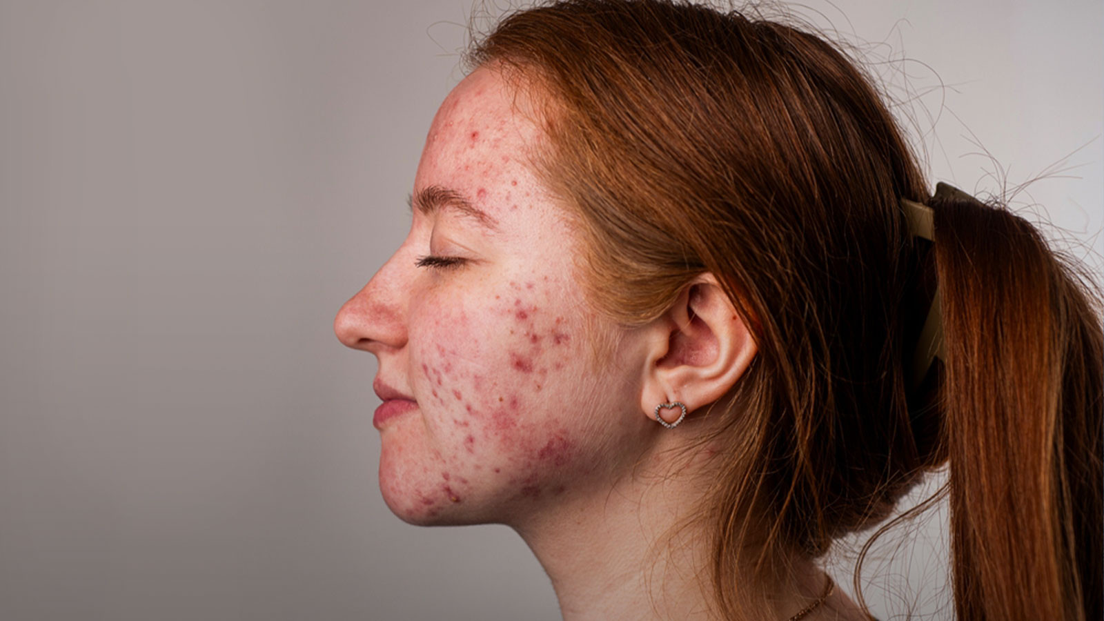 Akne’de koruyucu hekimlik kritik Akne’de koruyucu hekimlik kritik