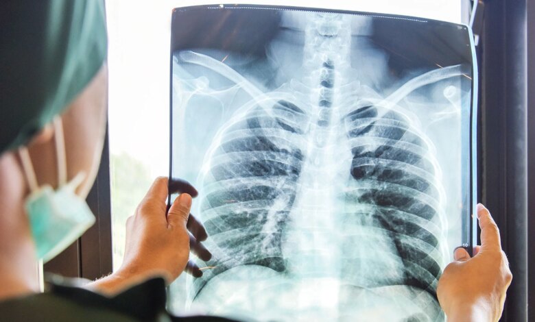 Türkiye’de 3 Milyon Kişi KOAH Hastalığının Farkında Değil Türkiye’de 3 Milyon Kişi KOAH Hastalığının Farkında Değil